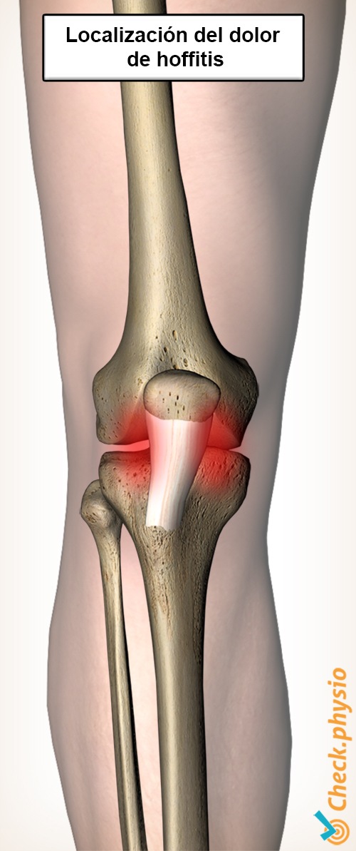 rodilla ubicación del dolor de hoffitis