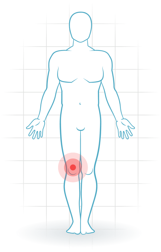 pijnlocatie Tendinitis del cuádriceps